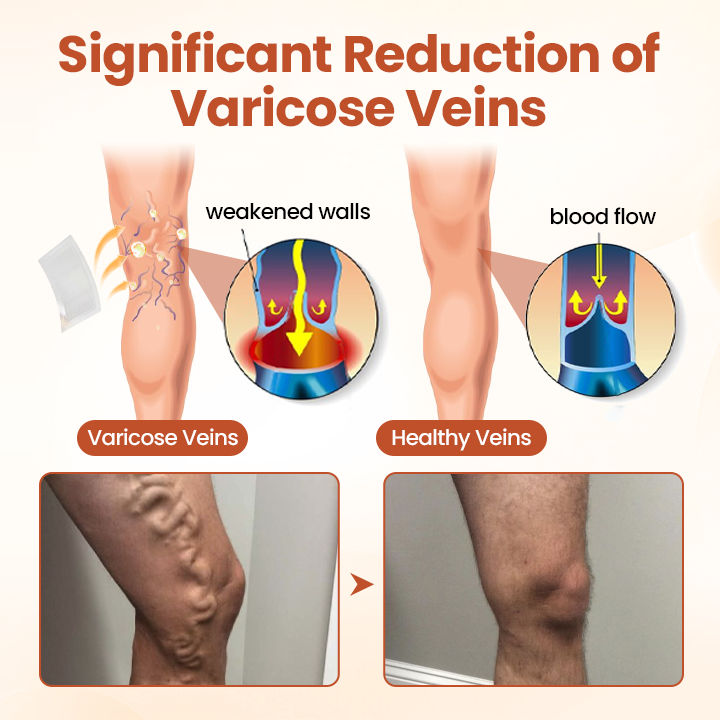 Tired of Aching, Bulging Varicose Veins? Get Targeted Relief in Just 7 Days with These Patches!