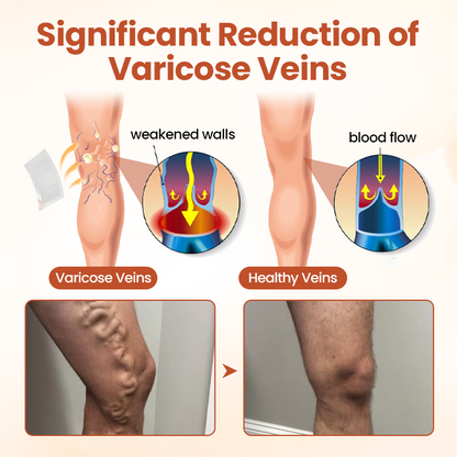 Tired of Aching, Bulging Varicose Veins? Get Targeted Relief in Just 7 Days with These Patches!