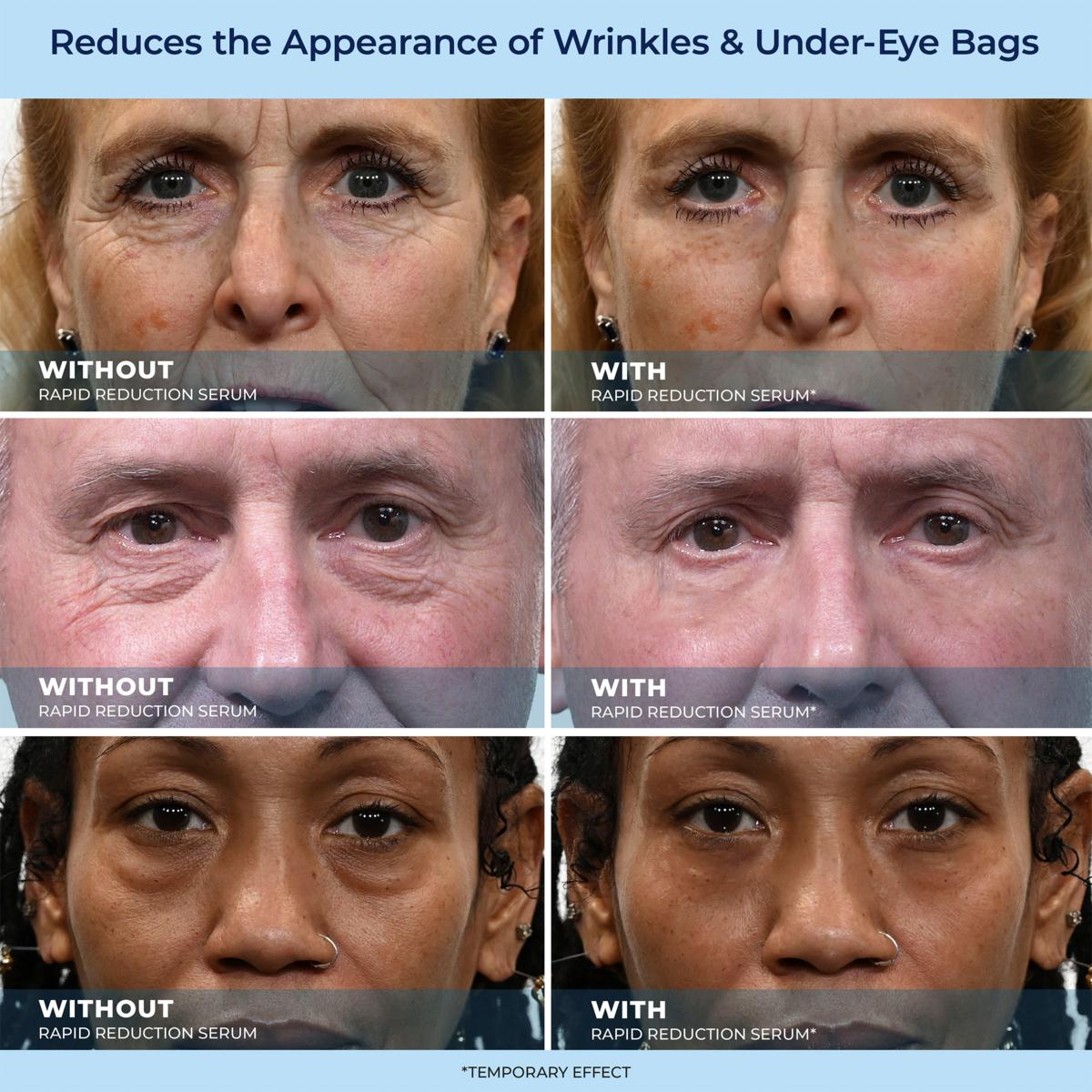 🔥Last Day Promotion 70% OFF Shinneey™ Savior for Eye Bags