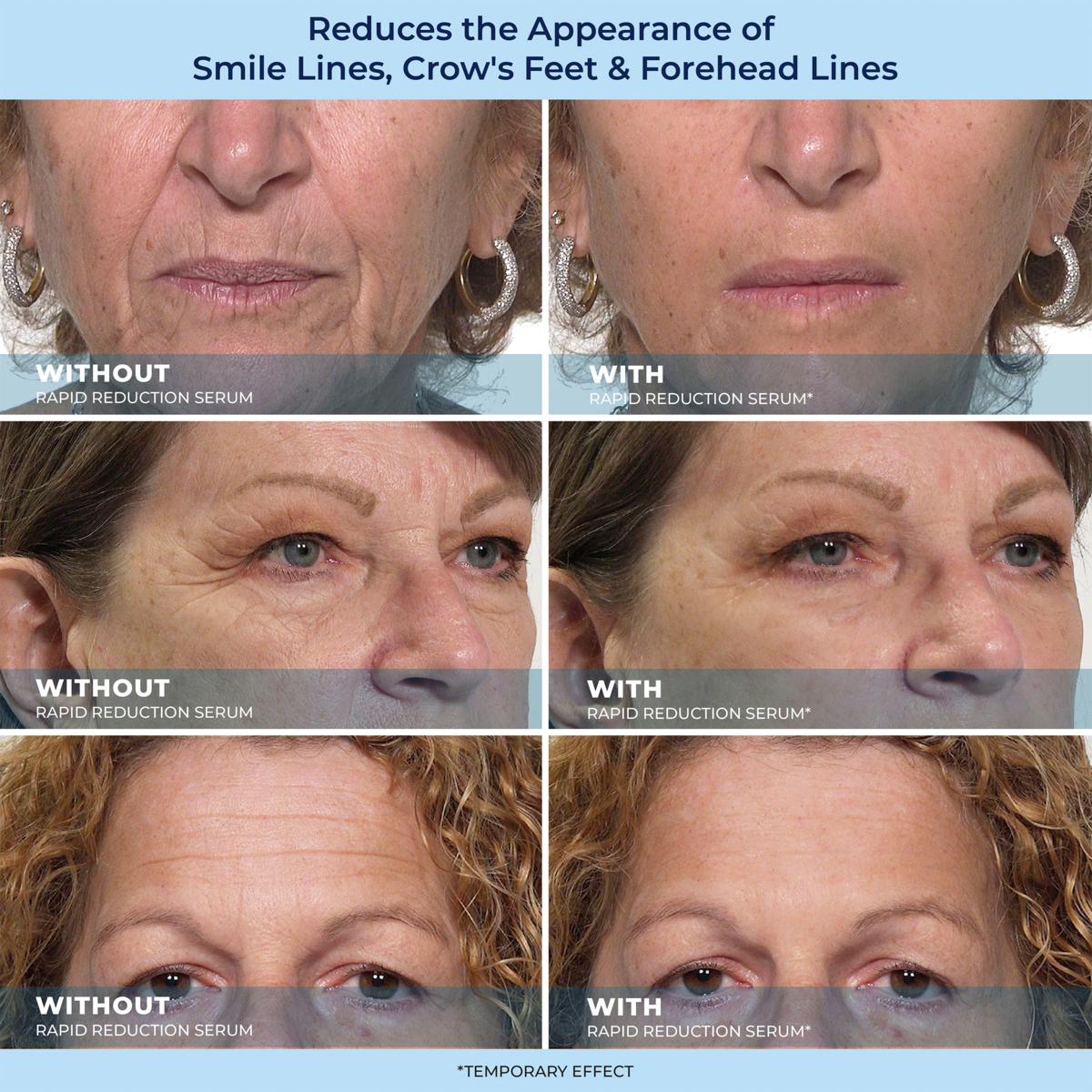 🔥Last Day Promotion 70% OFF Shinneey™ Savior for Eye Bags